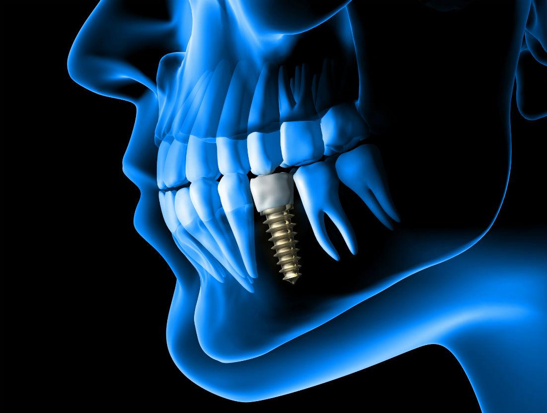 Dental Implants Yorba Linda, CA